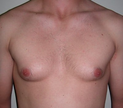 Before Image: 23 Years Old 3 Months Post-Op - front