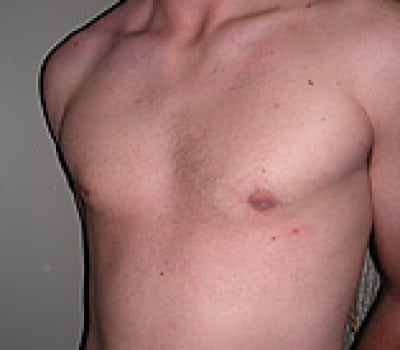 After Image: 23 Years Old 3 Months Post-Op - other