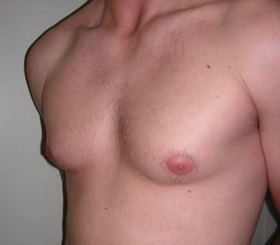 Before Image: 23 Years Old 3 Months Post-Op - other