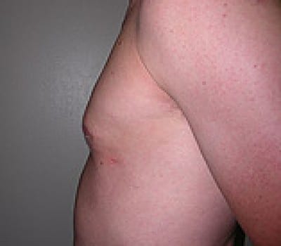 After Image: 23 Years Old 3 Months Post-Op - other