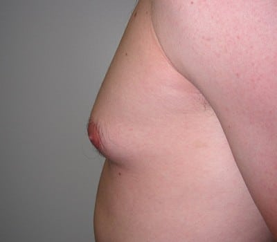 Before Image: 23 Years Old 3 Months Post-Op - other