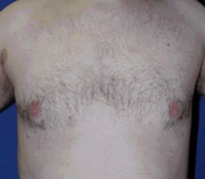 After Image: 24 Years Old 3 Months Post-Op - front
