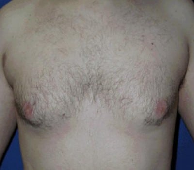 Before Image: 24 Years Old 3 Months Post-Op - front