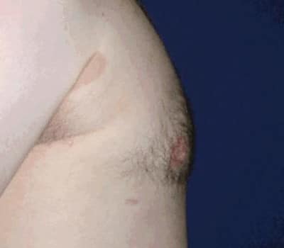 After Image: 24 Years Old 3 Months Post-Op - right-side