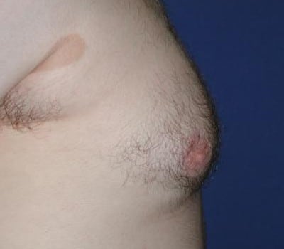 Before Image: 24 Years Old 3 Months Post-Op - right-side