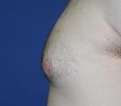 Before Image: 24 Years Old 3 Months Post-Op - left-side