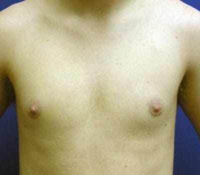 After Image: 19 Years Old 3 Months Pre-Op - front
