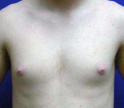 Before Image: 19 Years Old 3 Months Pre-Op - front