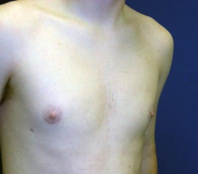 After Image: 19 Years Old 3 Months Pre-Op - other