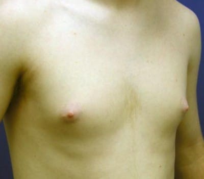 Before Image: 19 Years Old 3 Months Pre-Op - other