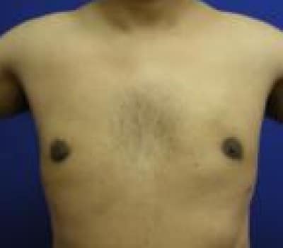 After Image: Reduced Breasts & Nipple Fullness - front