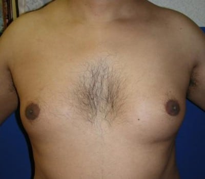 Before Image: Reduced Breasts & Nipple Fullness - front