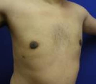 After Image: Reduced Breasts & Nipple Fullness - other