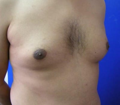 Before Image: Reduced Breasts & Nipple Fullness - other