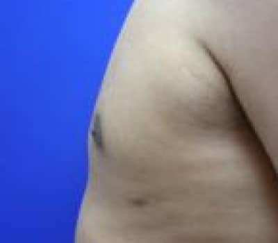 After Image: Reduced Breasts & Nipple Fullness - other