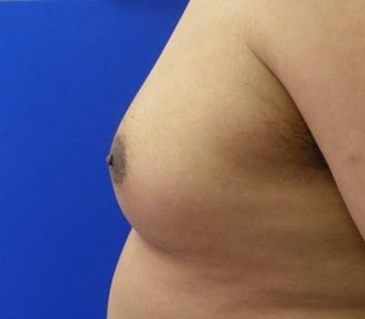 Before Image: Reduced Breasts & Nipple Fullness - other