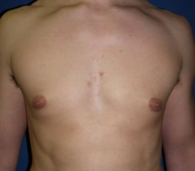 After Image: 24 Year Old 4 Months Pre-Op - front
