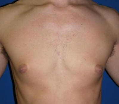 Before Image: 24 Year Old 4 Months Pre-Op - front