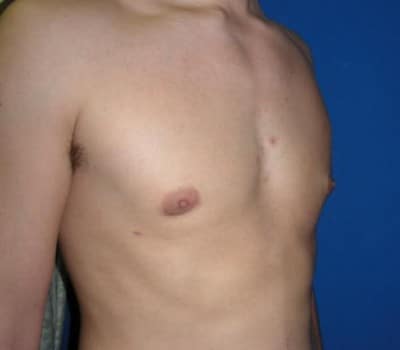 After Image: 24 Year Old 4 Months Pre-Op - other