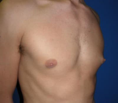 Before Image: 24 Year Old 4 Months Pre-Op - other
