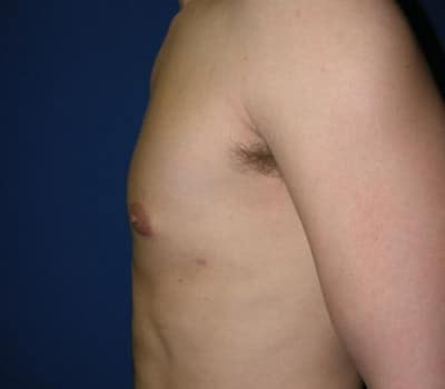 After Image: 24 Year Old 4 Months Pre-Op - other