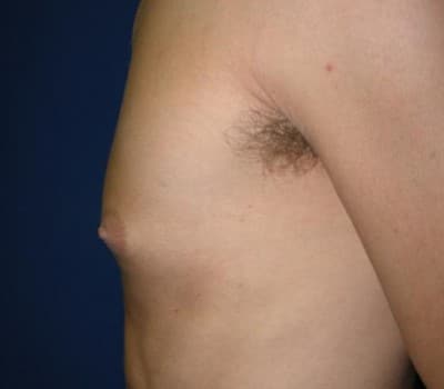 Before Image: 24 Year Old 4 Months Pre-Op - other