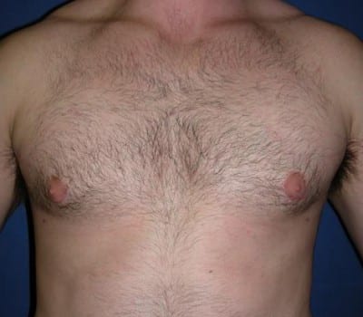 After Image: 21 Years Old 4 Months Post-Op - front