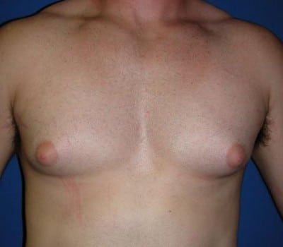 Before Image: 21 Years Old 4 Months Post-Op - front