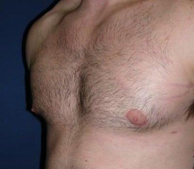 After Image: 21 Years Old 4 Months Post-Op - other
