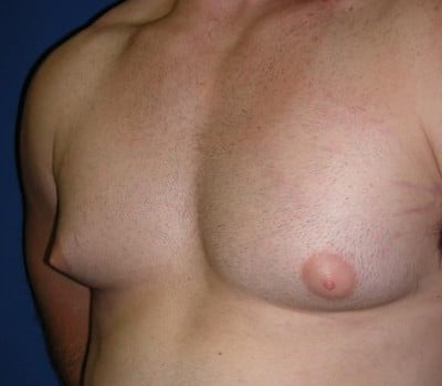 Before Image: 21 Years Old 4 Months Post-Op - other