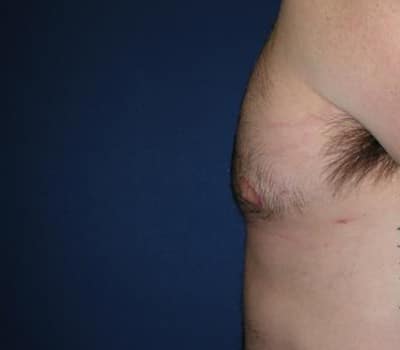 After Image: 21 Years Old 4 Months Post-Op - other
