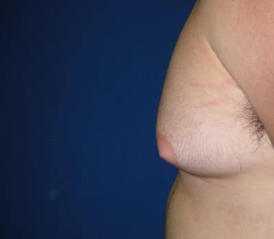 Before Image: 21 Years Old 4 Months Post-Op - other