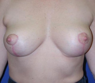 After Image: 52 Years Old Mastopexy - front