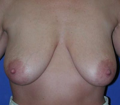 Before Image: 52 Years Old Mastopexy - front