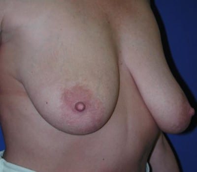 Before Image: 52 Years Old Mastopexy - other