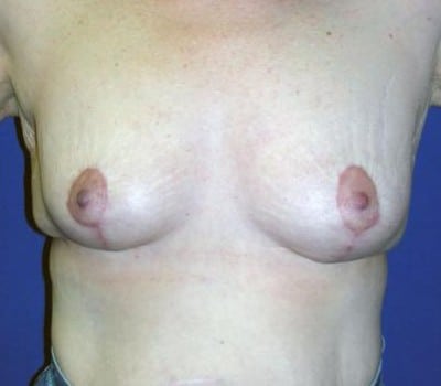 After Image: Breast Lift Without Implant - front