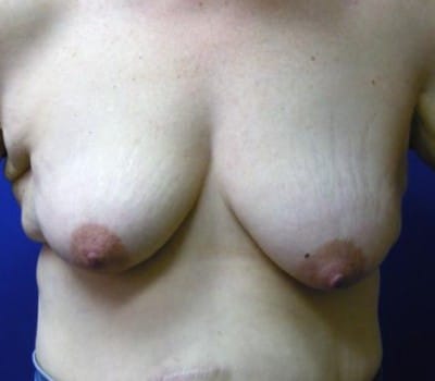 Before Image: Breast Lift Without Implant - front