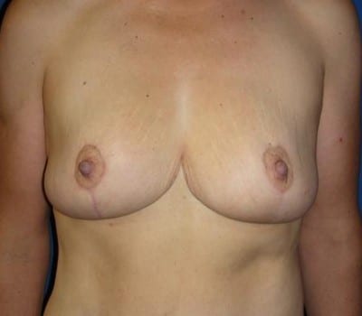 After Image: Bilateral Breast Lift - front