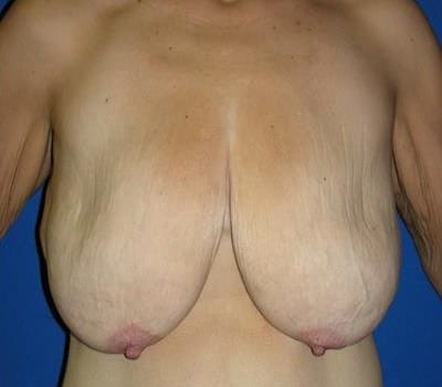 Before Image: Bilateral Breast Lift - front