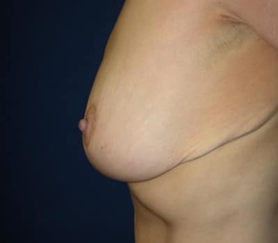 After Image: Bilateral Breast Lift - other