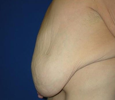 Before Image: Bilateral Breast Lift - other