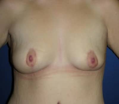 After Image: Bilateral Breast Lift - front