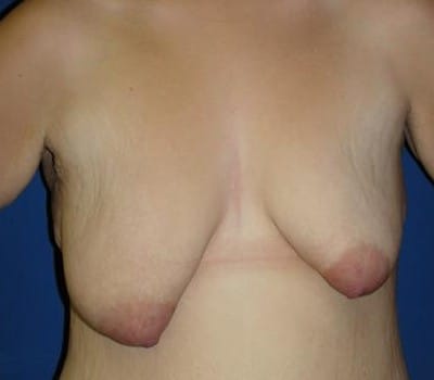 Before Image: Bilateral Breast Lift - front