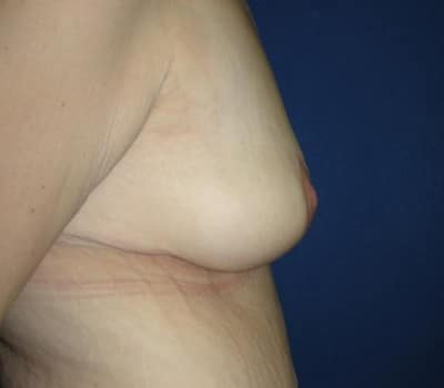 After Image: Bilateral Breast Lift - right-side
