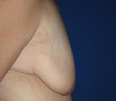 Before Image: Bilateral Breast Lift - right-side