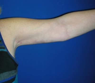 After Image: Bilateral Arm Lift 3 Months Post-Op - left-side