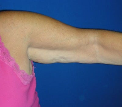 Before Image: Bilateral Arm Lift 3 Months Post-Op - left-side