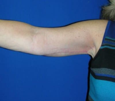 After Image: Bilateral Arm Lift 3 Months Post-Op - right-side