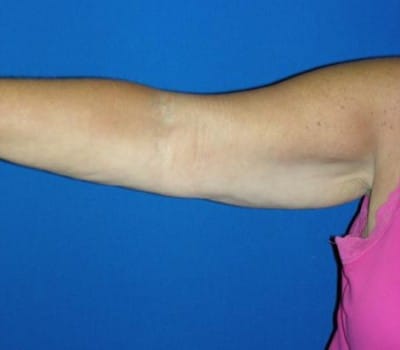 Before Image: Bilateral Arm Lift 3 Months Post-Op - right-side