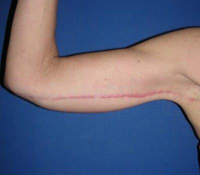 After Image: Inner Arms Excess Skin Removal - right-side